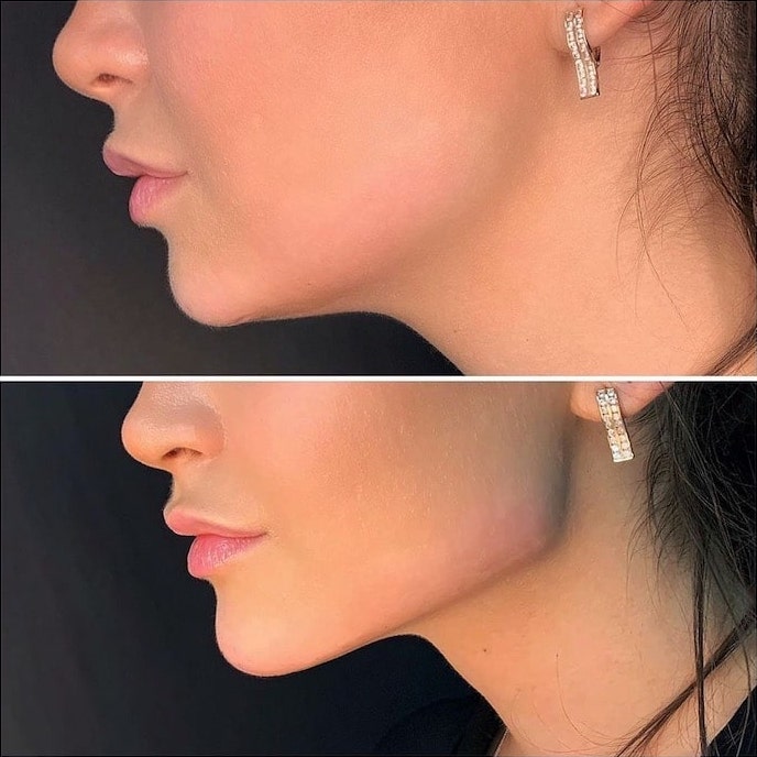 دكتورة فيلر في جدة