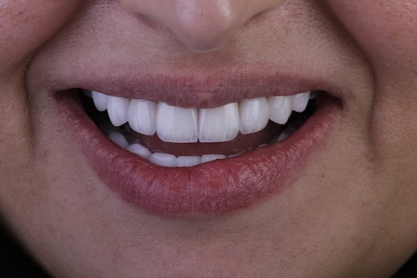 افضل دكتور ابتسامة هوليود في دبي، فينير الاسنان في دبي، عيادة تجميل الأسنان