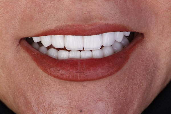 افضل دكتور ابتسامة هوليود في دبي، فينير الاسنان في دبي، عيادة تجميل الأسنان