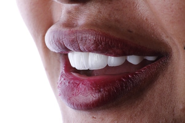 افضل دكتور ابتسامة هوليود في دبي، فينير الاسنان في دبي، عيادة تجميل الأسنان