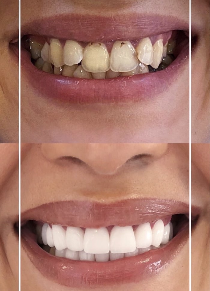 افضل دكتور ابتسامة هوليود في دبي، فينير الاسنان في دبي، عيادة تجميل الأسنان