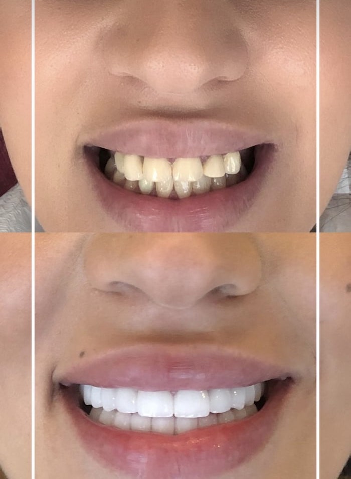 فينير الاسنان في قطر - افضل دكتور ابتسامة هوليود في قطر